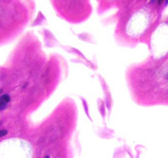 Giardiasis